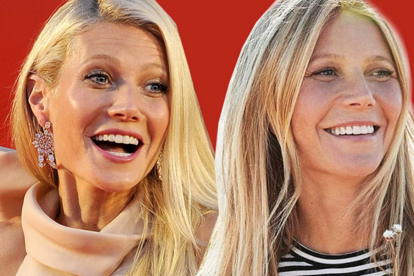 Celebrities cheek filler before and after