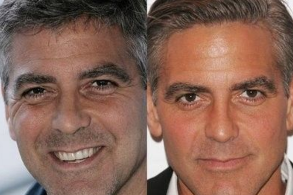 Celebrities cheek filler before and after
