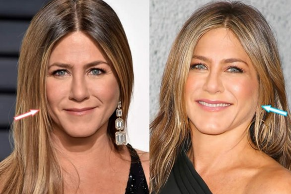 Celebrities cheek filler before and after