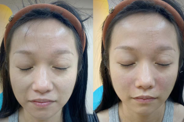 dermal filler before and after