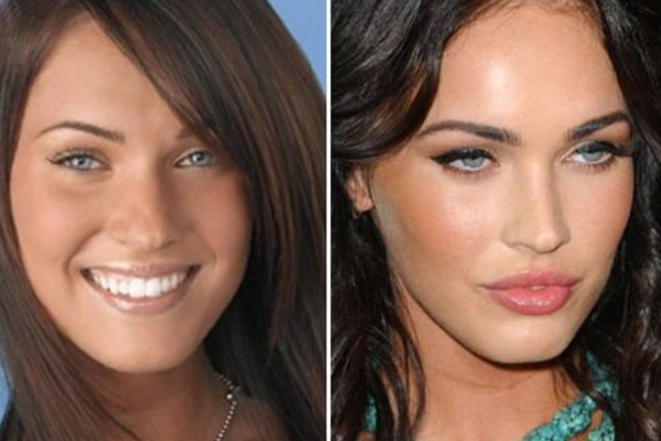 celebrity with cheek fillers