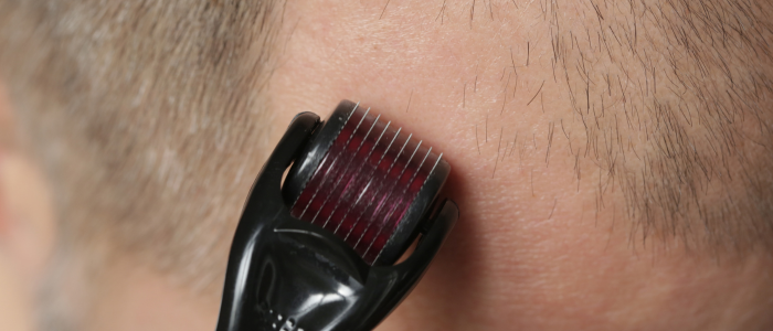 derma roller and minoxidil
