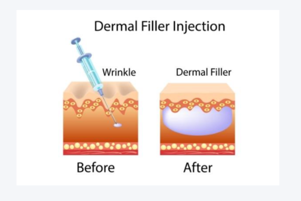 the fuction after using the collagen threads at home