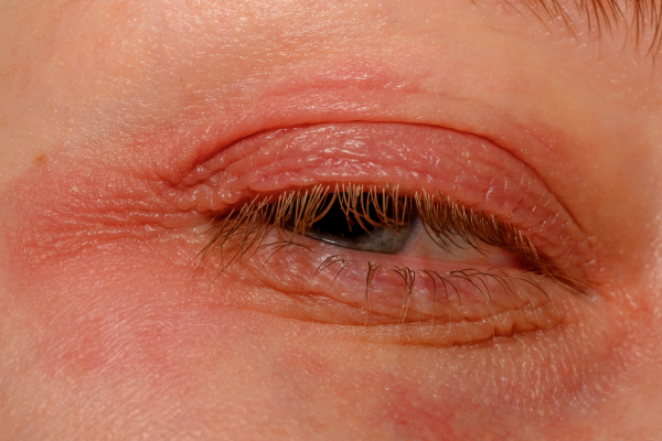 redness and swelling after PDO thread lift