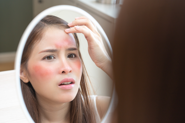face redness