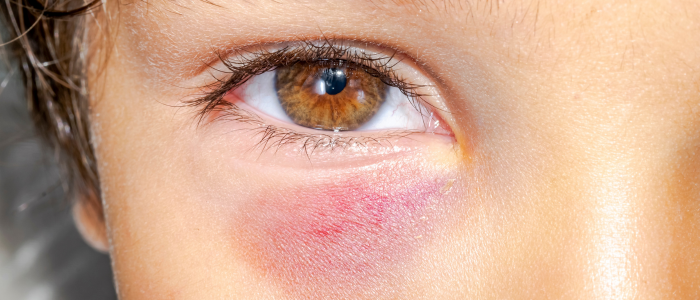 under eye filler complication
