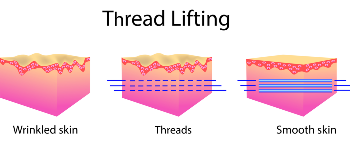 function after the collagen threads at home