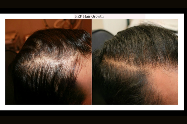 prp for hair loss