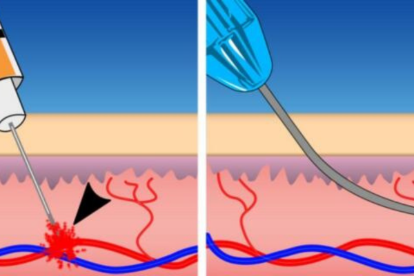 best cannula for filler injection
