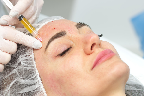 what is vampire facial