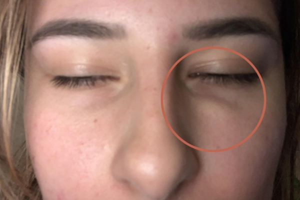 Under Eye Filler complications