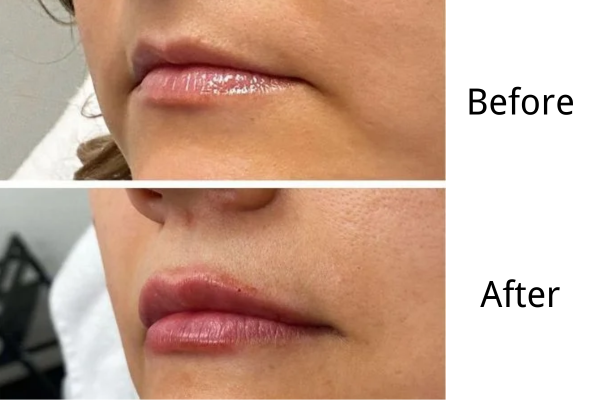 What to Expect The First Day After Lip Injections