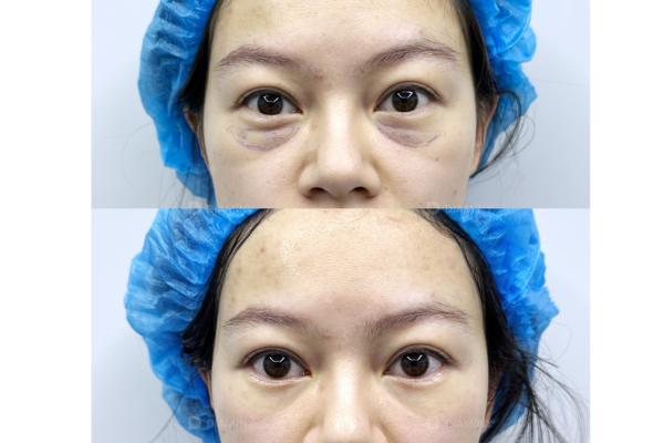 PDO Threads under eyes before and after