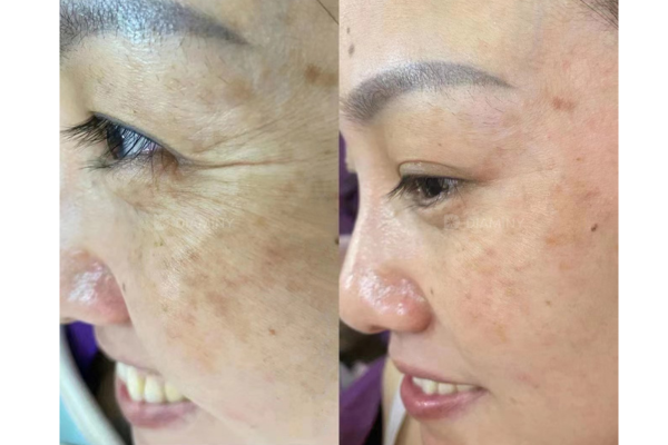 PDO Threads under eyes before and after