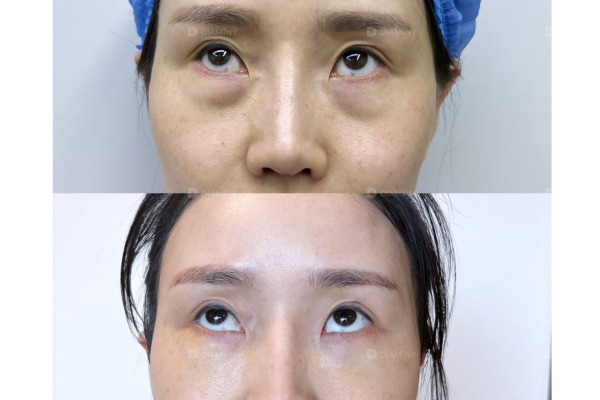 PDO Threads under eyes before and after