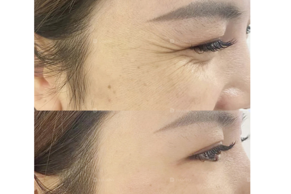 PDO Threads under eyes before and after