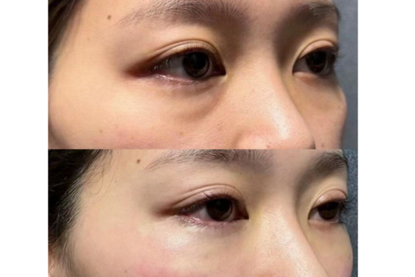 PDO Threads under eyes before and after