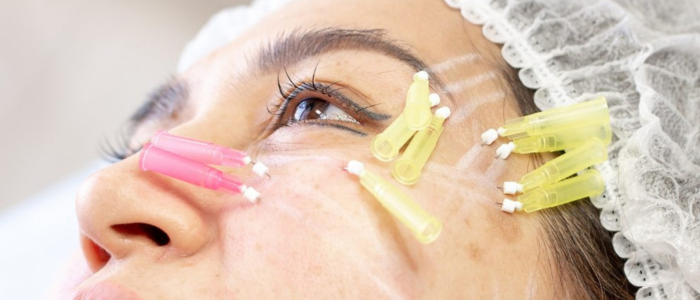 PDO Threads under Eyes Before and After Results