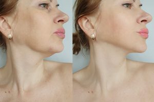 Woman,Double,Chin,After,Treatment