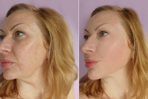 Woman,Face,Wrinkles,Before,And,After,Treatment