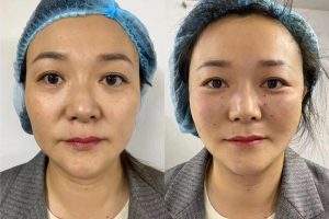 before & after 4