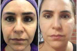 before & after 6