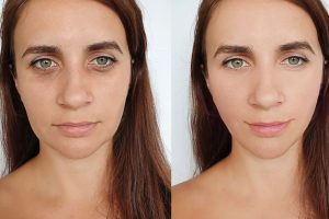 Woman,Face,Wrinkles,Before,And,After,Treatment