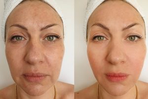 Woman,Face,Wrinkles,After,Treatment